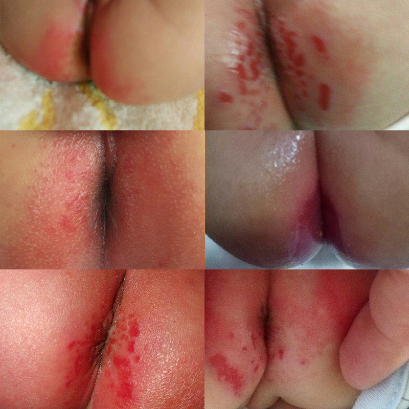 Baby red wet broken skin natural camellia oil newborn pickled legs massage touch baby's butt PP buttock oil