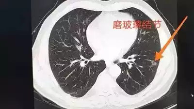 Xiangxi Wulong Mountain Chinese herbal medicine lung nodules lung ground glass nodules solid nodules