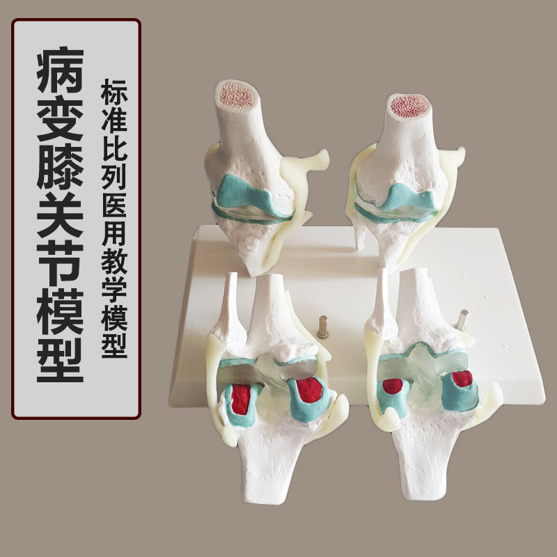 人体病理膝关节模型?病变?膝关节退行性膝关节/病?关节镜手术