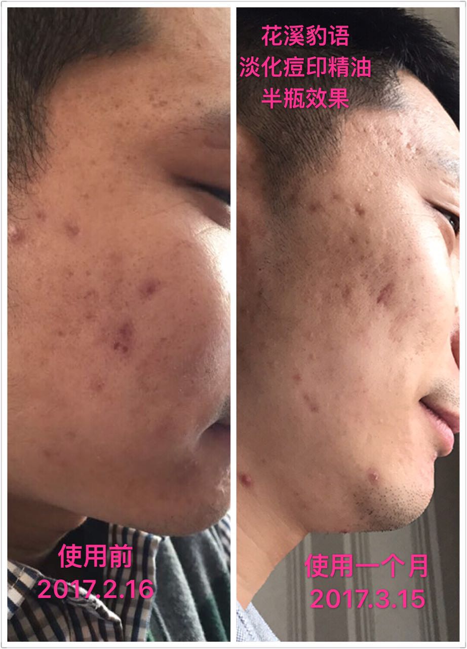 Purring Leopard đối tác trị mụn làm mờ vết mụn trứng cá dầu nhạt NAHA aromatherapist đặt hàng riêng 5ML tinh dầu húng chanh minion
