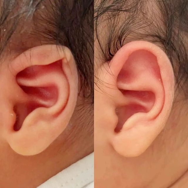 Baby auricle correction artifact baby ear lop ear flapping ear ear clip shaping newborn silicone ear deformity