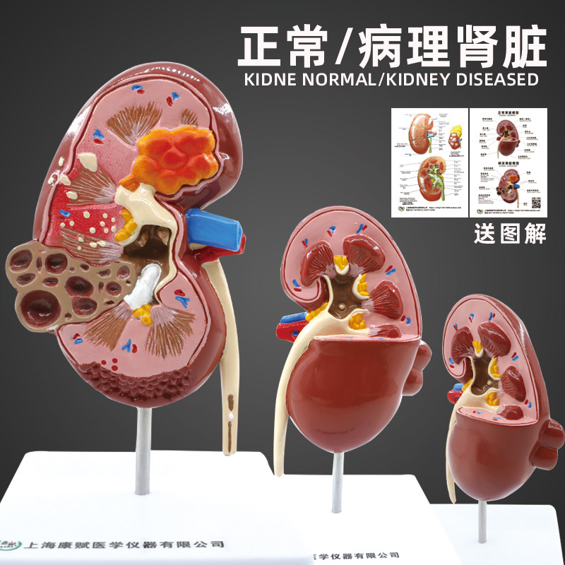人体肾解剖模型 病变肾脏模型 肾脏模型 人体内脏器官解剖模型