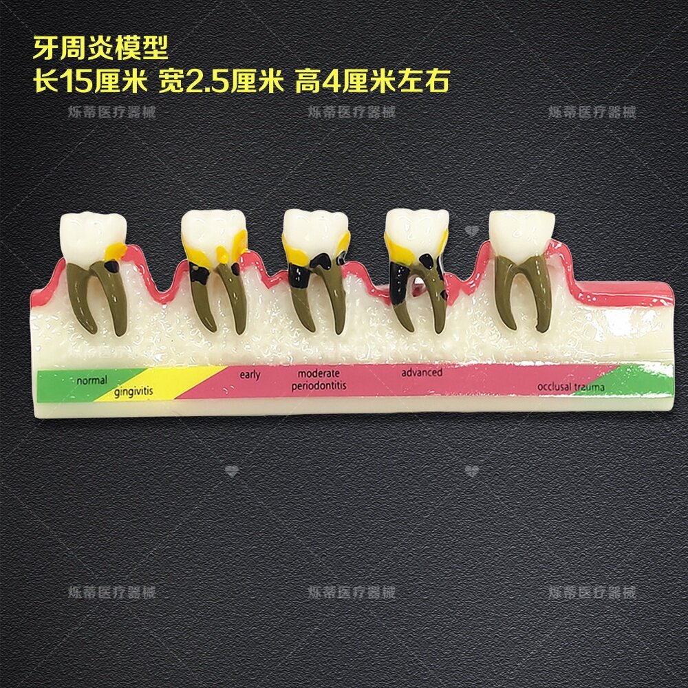 牙科口腔龋齿演变讲解分析牙周炎模型 学习教学牙模 医患沟通