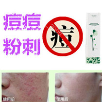Acne removal on chest and back acne oily acne scars flat closed acne fat particles elimination cream