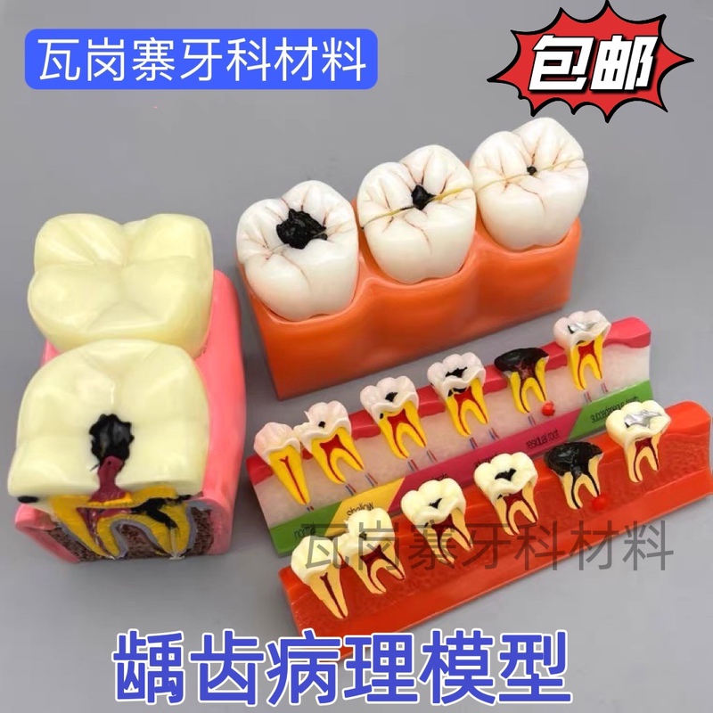Dental Oral Model 6X Caries Comparison 4X Caries Breakdown 2X Tooth Development Evolution Cavities and Teeth Dental Oral Model 6X Caries Comparison 4X Caries Breakdown 2X Tooth Development Evolution Cavities and Teeth