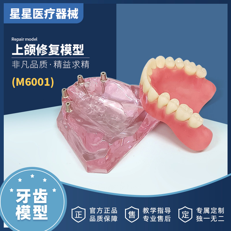 牙齿口腔教学牙科上颌4颗微型种植钉义齿修复可拆卸医患沟通模型