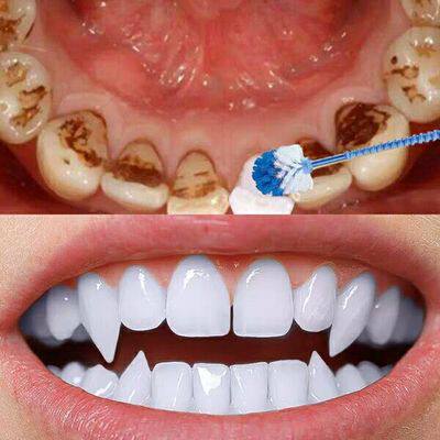 (Recommended by Xiaohongshu) White teeth are more beautiful. Smoke stain tea teeth nemesis, teeth yellowing and whitening artifact buy 2 get 1 free
