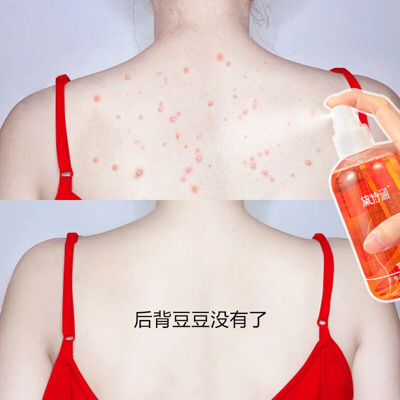 (Do not back bean beans) Matran Dorsal Spray Fluid Back back Acne God to remove the mites from the front chest powder