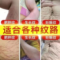 Stretch mark removal obesity mark repair cream thigh and belly growth stretch mark postpartum firming and fading scar removal cream