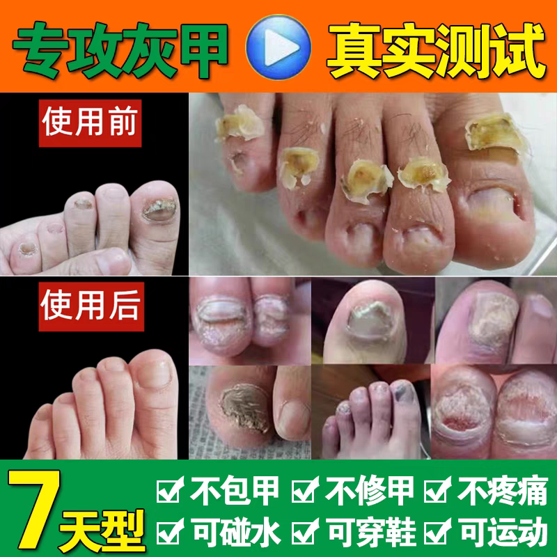 Specialized Nail Fungus Solution, Phlox Flower Antibacterial Liquid, Nail Brightening, Japanese Nail Removal Cream, Imported Nail Care Tool, Genuine Product