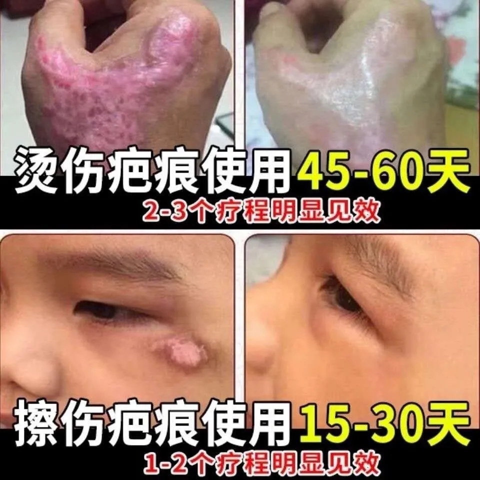 Nanjing Tongrentang Scar Removal Cream Scar Removal Surgery Bump Proliferation Scar Spirit One Wipe Eliminates Special Old Scar Repair