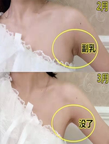 Go to sub-miller axillary lymph nodes Lymph Nodes Swell Large Dredge Draining of Breast Lymphatic Lymphatic Patch to the Breast Elimination of Breast Lymph