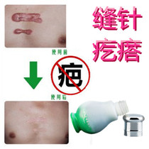 Cesarean section pimple removal body bulge surgery postpartum care incision scar removal stitch removal needle product medicine