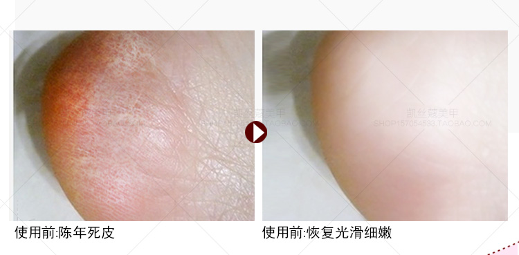 Care 迪 黄金 Chăm sóc chân collagen đặt kem dưỡng da cho da chết vào bộ phim chân công cụ dưỡng ẩm cũ thuốc trị nứt chân