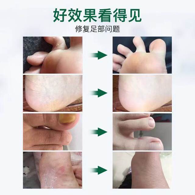 Authentic Qinyitang Fungus King Antibacterial Liquid Peeling Onychomycosis Skin Treatment Ointment Official Website