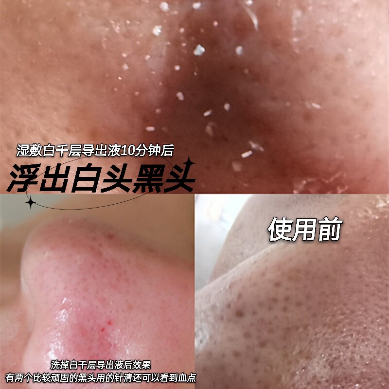 Japanese laboratory de-blackhead export liquid rosacea essence to shrink pores, wash-free closed mouth, whitehead acne