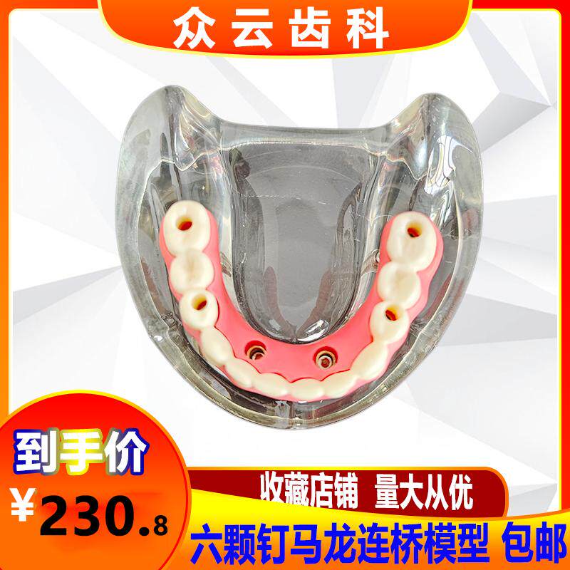 牙科种植体修复模型种植钉球帽结合半口综合病理种植与无牙颌模型