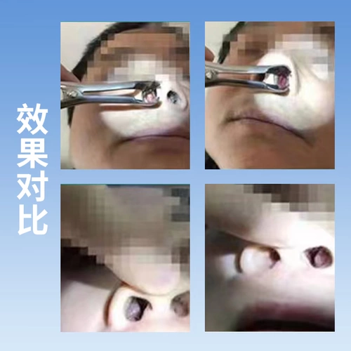 Японский ринит распылительный аллергический синусит ринит носовой носовой гипертрофический назальный застой и носовые артефакты