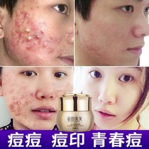 Pimple acne students printed on the back of acne mites back to acne cream extract Fran Acne Repair Cream