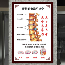 Traditional Chinese Medicine Spine Spine Common Lesion Propaganda Hung Painting Waist Disc Herniated Disc Related Disease Schematic Wall Stickers Poster