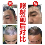 Xili Si Zunpu и используйте жалкую  Jia pochu, чтобы расслабиться? 11 -нм узкий спектр UVB