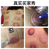 Вакуумное устройство для домашнего набора рисования пня, инструмент для обручения, портативная медицинская коробка, китайская медицина Специальный инструмент для купировки