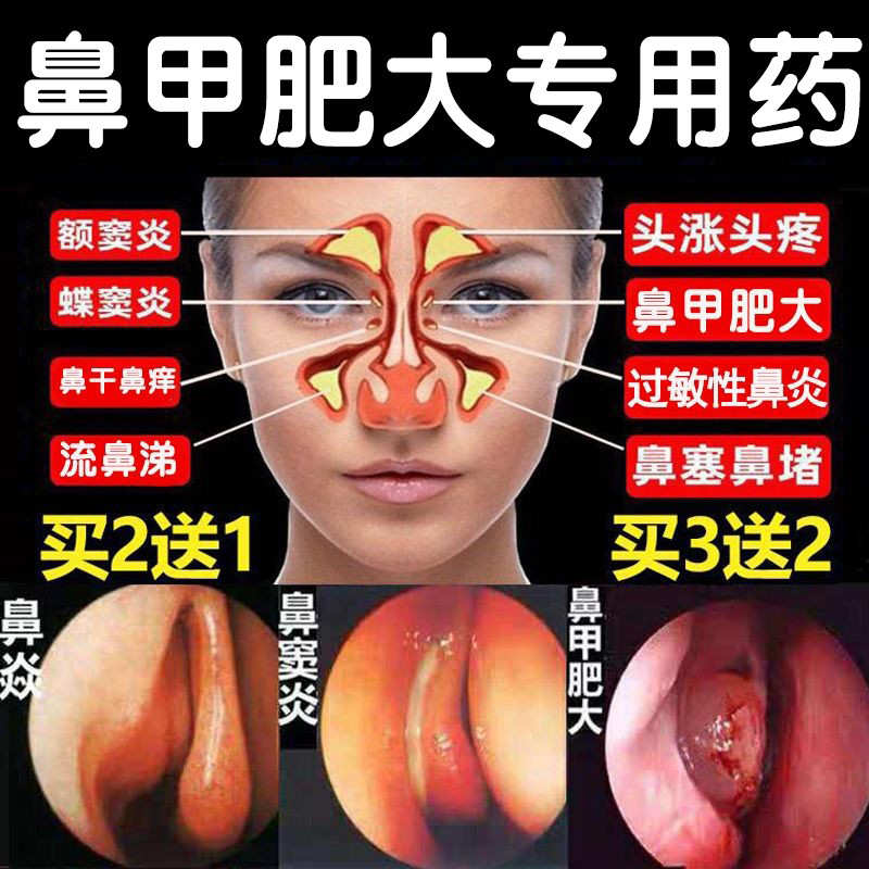 Allergic Nasal Cream Radical Sinusitis Nasal Sinusitis Home Goose Uncanny Grass Seedling Drug Rhinocera Fats Specialty Medication