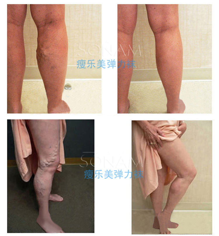 Vớ tĩnh mạch Zhang chống cơ khí stretch skinny quần ba cấp phần mỏng romper y tá hậu phẫu thrombosis mùa xuân và mùa hè nam giới và phụ nữ y tế