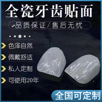 Imported blue porcelain amber Lingxi porcelain all-ceramic teeth whitening all-ceramic veneers whitening and repairing teeth veneers are customized nationwide