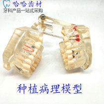Dental model Oral teaching model Dental model Orthodontic mold Dental model implant model Restoration model