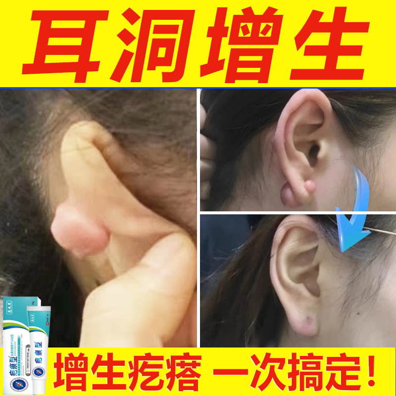 Ear Bump Scar Hyperplasia Protrusion Softening Needle Removal Repair Cream for Removing Ear Bone, Earlobe, Ear Piercing Scars, and Auricle Scars