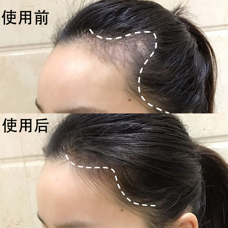 (Farewell to the big forehead) Hairline natural growth of hair speed do not bald brain door recommended buy two get one free