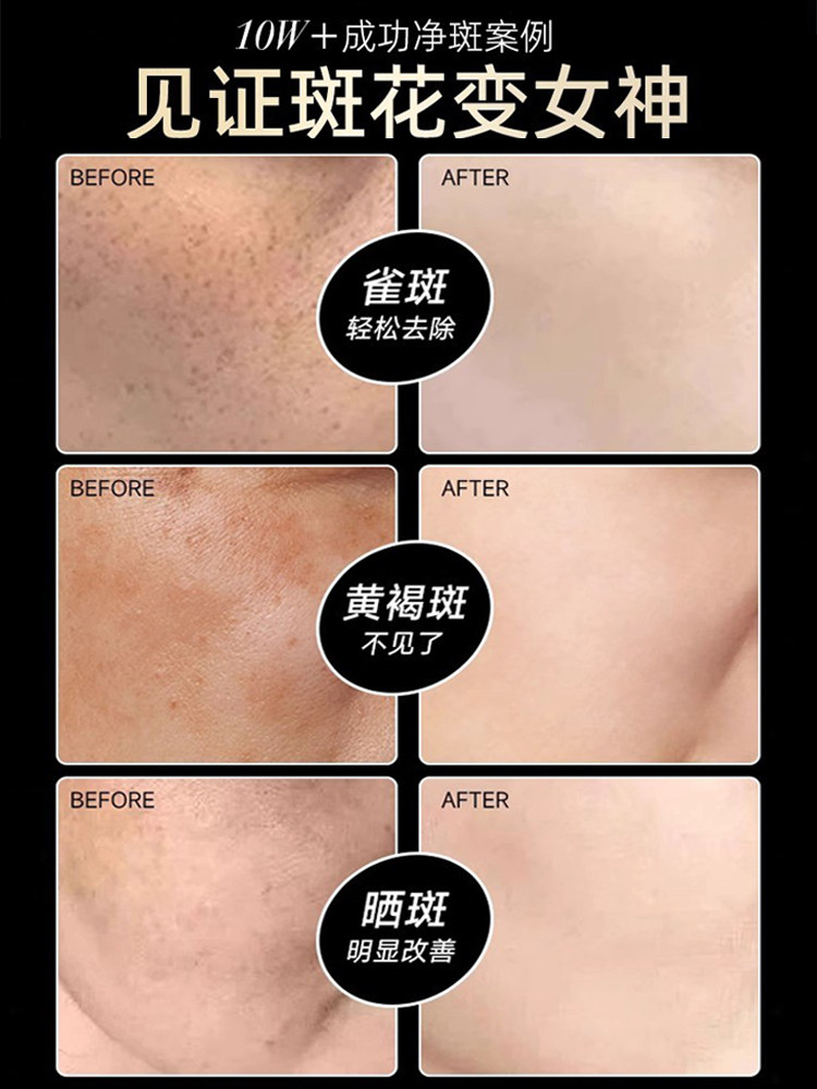 Black Bandage Whitening and Freckle Removal Cream, Niacinamide, Removes Chloasma, Age Spots, and Freckles, Special Morning and Night Cream, Official Authentic Product