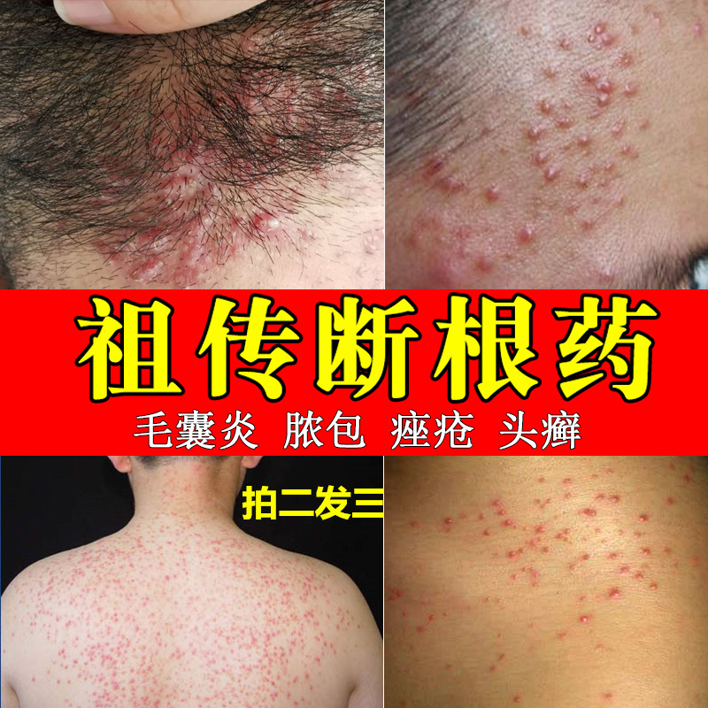 Removal of folliculitis, seborrheic dermatitis, scalp and head pustules, dandruff, tinea capitis, ointment, fungal infection, moss
