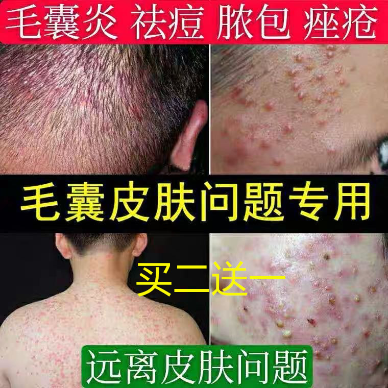 Treatment of folliculitis fungal infection seborrheic dermatitis scalp head pustules acne acne dandruff special ringworm ointment