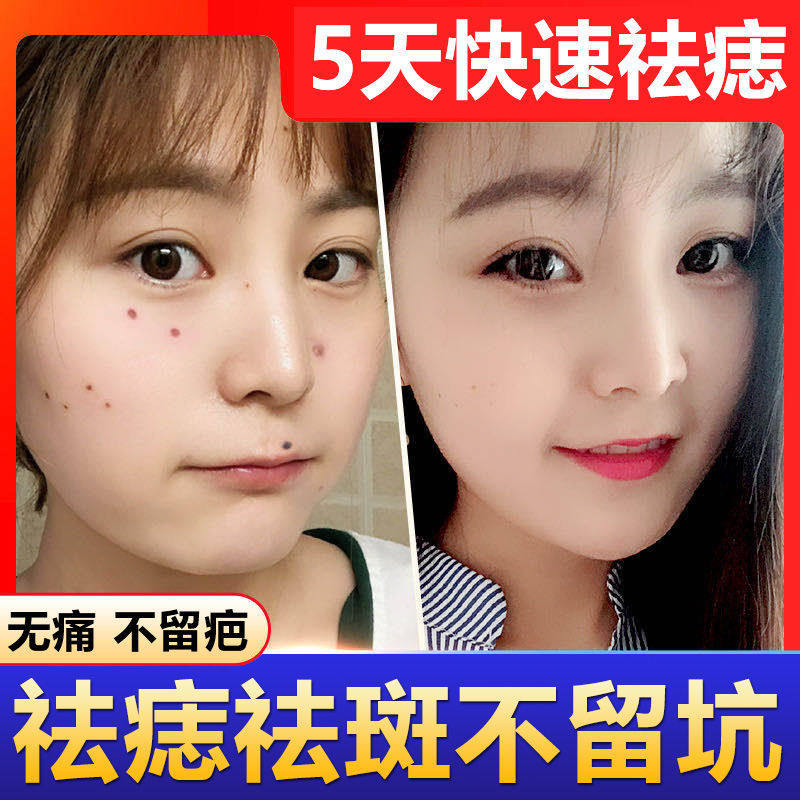 Mole Removal Potion Mole Removal Cream Spot Mole Removal Ling Spot Water Freckle Removal Mole Pen Freckle Removal Products Facial