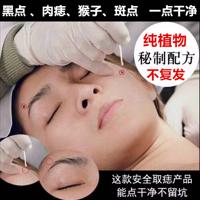 Mole Removing Mole Potion Facial Freckle Artifact Spot Water Beauty Salon Mole Removal Cream Traceless Pen Special Instrument Liquid