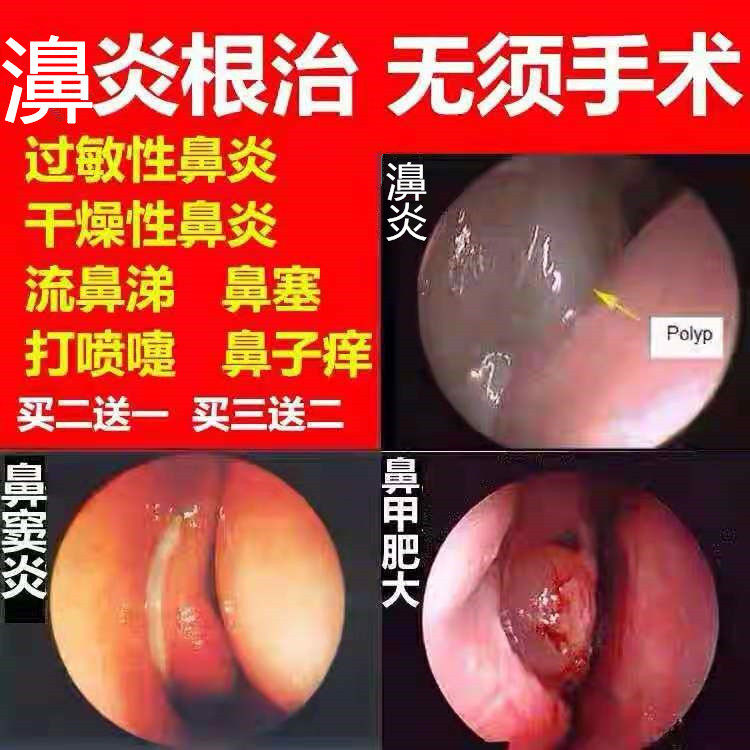 Nasal Wei Yan cream cure nasal congestion runny nose Allergic Wei yan turbinate hypertrophy sinusitis nose does not air artifact