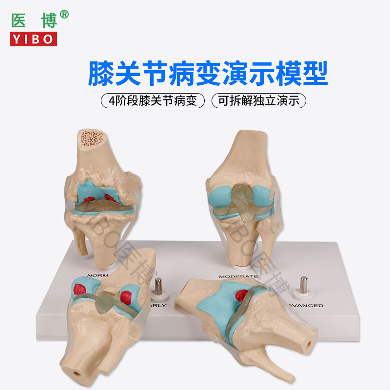 医博BIX-A3571膝关节病变模型 人体骨骼病变模型 人体膝关节4阶段病变模型