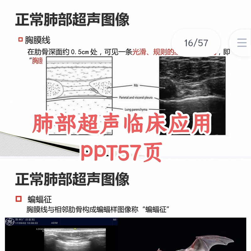 Lung Ultrasound Ppt Clinical Application Pleural Effusion Ultrasound Diagnosis Ppt Slide Presentation Image Diagnosis Lung Ultrasound Ppt Clinical Application Pleural Effusion Ultrasound Diagnosis Ppt Slide Presentation Image Diagnosis