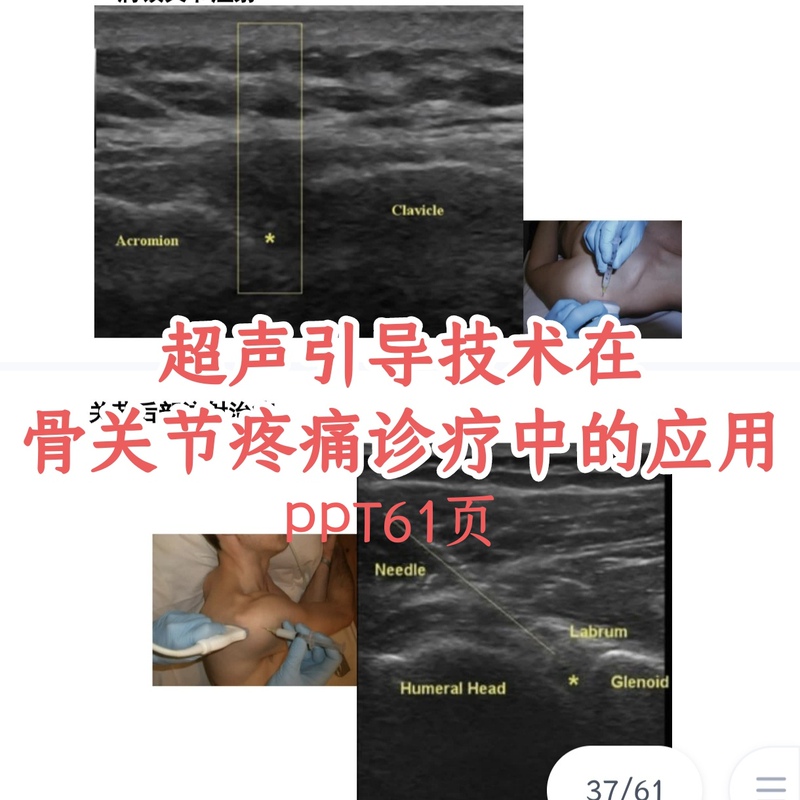 Application of Ultrasonography Technology in the Diagnosis and Treatment of Bone and Joint Pain Ppt Courseware Slides Application of Ultrasonography Technology in the Diagnosis and Treatment of Bone and Joint Pain Ppt Courseware Slides
