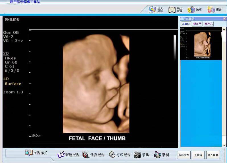 B-ultrasound software four-dimensional color ultrasound software endoscope gastroscope enteroscope otolaryngology uterine laparoscopy workstation software