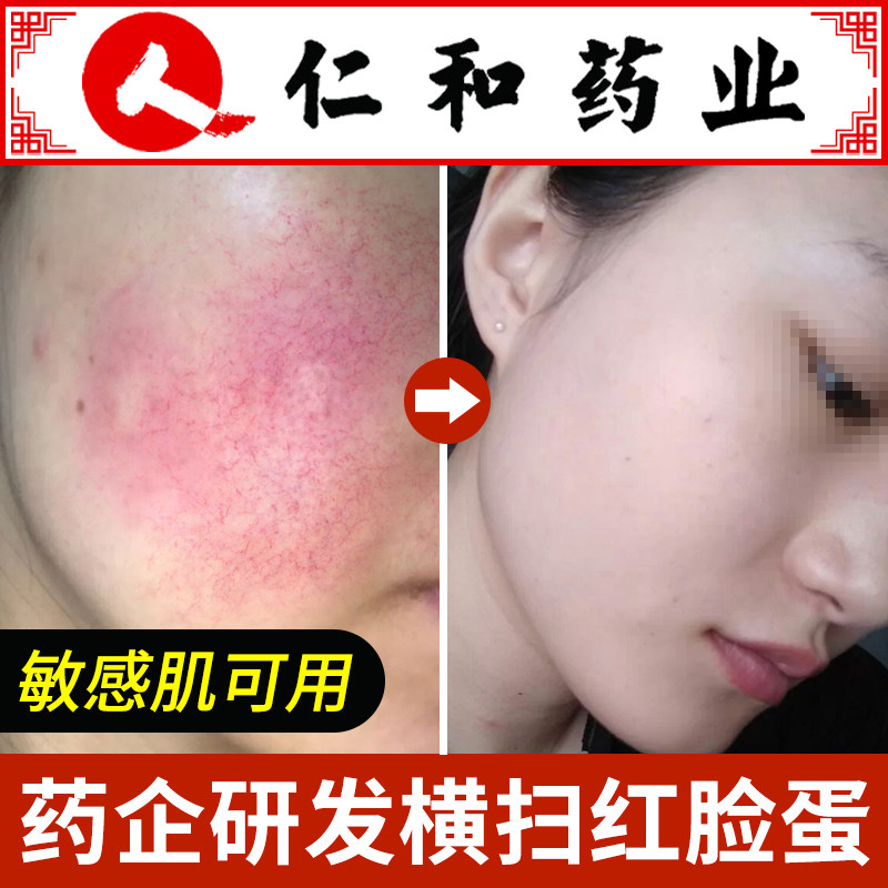Red blood sensitive skin stratum corneum plateau red improves erythroid hormone facial skin care repair non-removal repair
