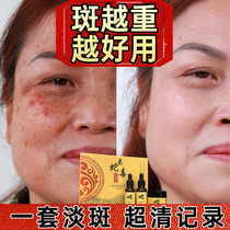  Whitening freckle cream to remove melanin light spots lighten pigmentation remove melasma freckles mens goddess device