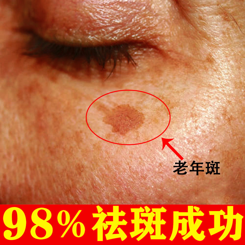 Hominin for removing plaque and macular macular macular macular macular macular removal of melanin hand face strongly removed