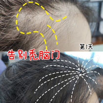 Hair growth liquid anti-hair loss hair growth dense development hair agent water male and female hair hairline rapid growth growth essence