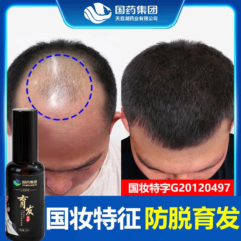 Anti-hair development hair lotion with hair loss and hair loss