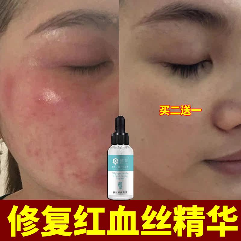 oc as dead essence to remove red blood streaks to repair stratum corneum to improve red plateau red hormone face skin care products sensitive muscle