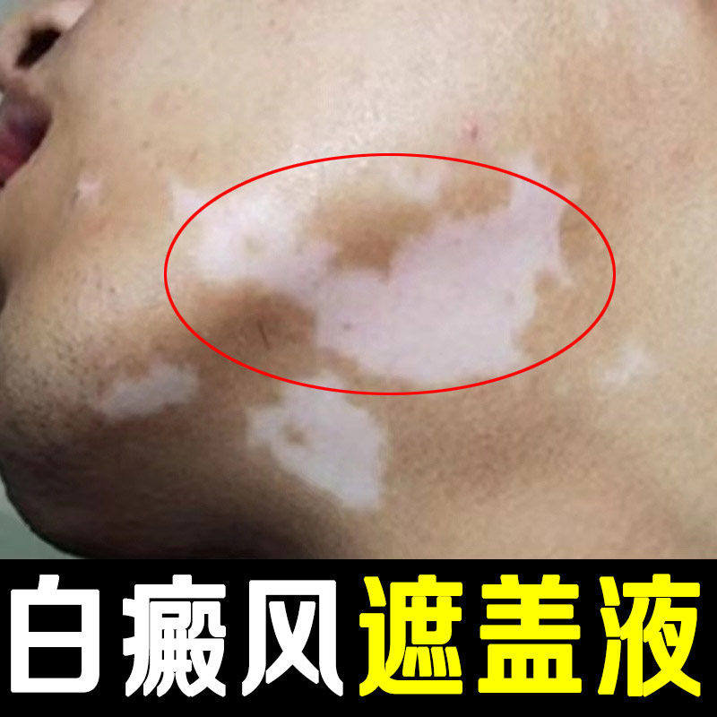Vitiligo Leucoplakia Covering Liquid Artifact Skin Color Full Body Waterproof and Sweatproof Lasting Face Hand Arm Concealer Pen