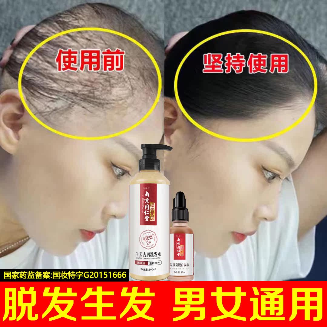 Ginger shampoo anti-exalpable male development hair growth and hair loss severe lady anti-desquiturizing anti-itch control oil